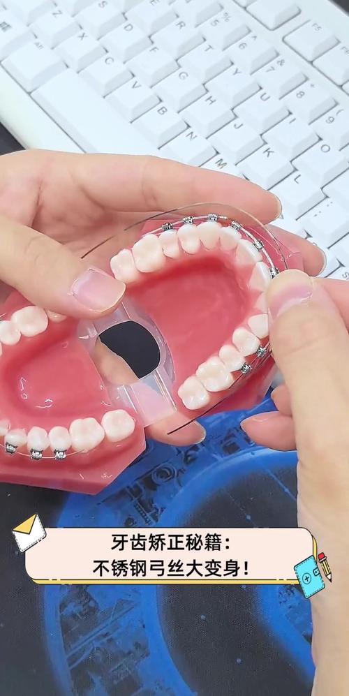 正畸弓丝为何要烧一下?这步操作对矫正有何关键作用?-图1 正畸弓丝为何要烧一下?这步操作对矫正有何关键作用?-图1
