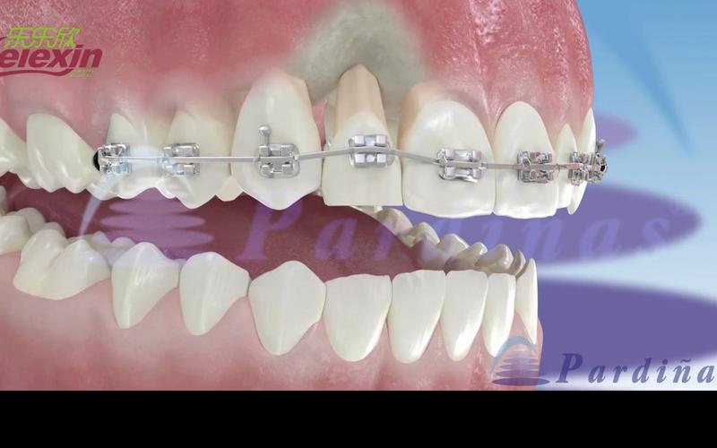 正畸牵引钩放哪里好？位置选择有啥讲究？-图3