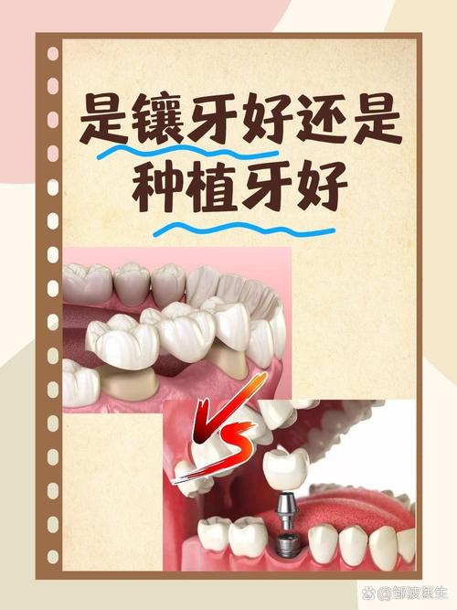 瑞典镶牙VS种牙，哪个更好？优缺点对比如何科学选？-图2