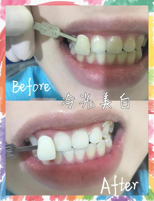 牙齿冷光美白的操作方法具体是什么？步骤详解看这里！-图1