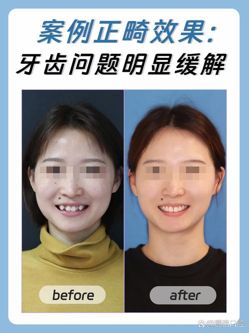 隐形正畸牙套一般要戴多长时间？-图3