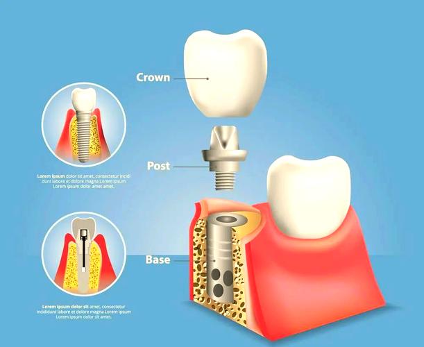 种植个性化基台制作需掌握哪些关键技术？-图3