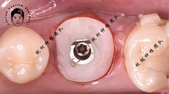 种植个性化基台制作需掌握哪些关键技术？-图2