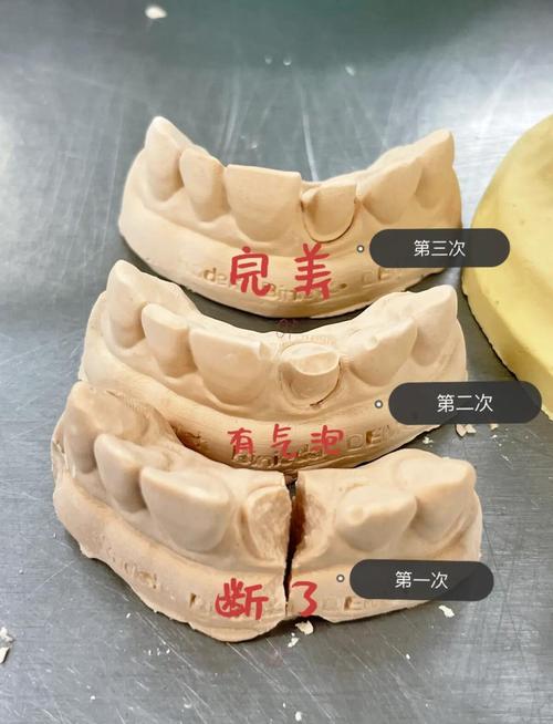 上颌牙局部义齿取模方法如何确保印模精准与舒适?-图2 上颌牙局部义齿取模方法如何确保印模精准与舒适?-图2