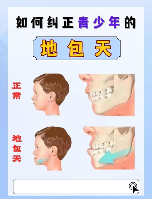 地包天正畸后反弹了怎么办?如何有效处理并预防反弹?-图2 地包天正畸后反弹了怎么办?如何有效处理并预防反弹?-图2