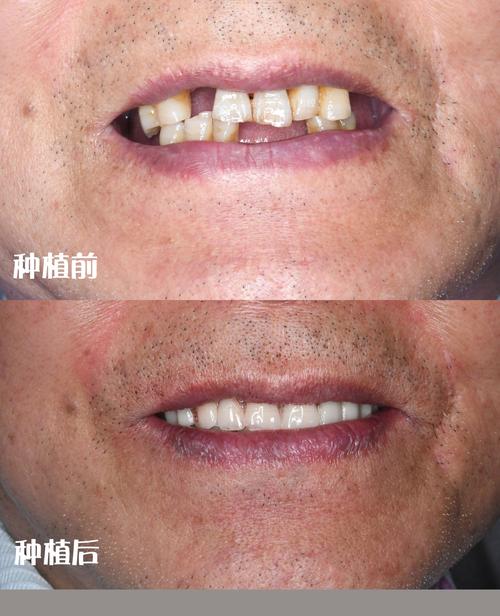 种牙后悔的真实案例,后悔的原因究竟有哪些?-图1 种牙后悔的真实案例,后悔的原因究竟有哪些?-图1