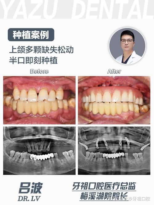 种牙后悔的真实案例,后悔的原因究竟有哪些?-图3 种牙后悔的真实案例,后悔的原因究竟有哪些?-图3