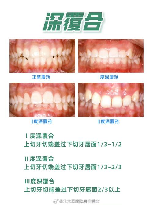 骨性深覆颌正畸效果到底好不好?-图2 骨性深覆颌正畸效果到底好不好?-图2