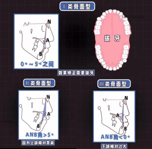 正畸治疗中什么时候需要粘接7号牙颊面管?-图2 正畸治疗中什么时候需要粘接7号牙颊面管?-图2