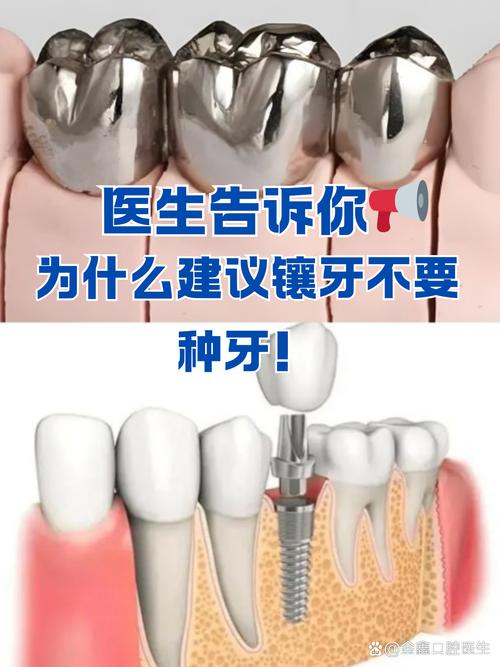 镶牙几年了 还能种牙吗-图2 镶牙几年了 还能种牙吗-图2