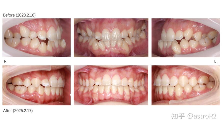 北大口腔医院正畸人多吗-图1 北大口腔医院正畸人多吗-图1
