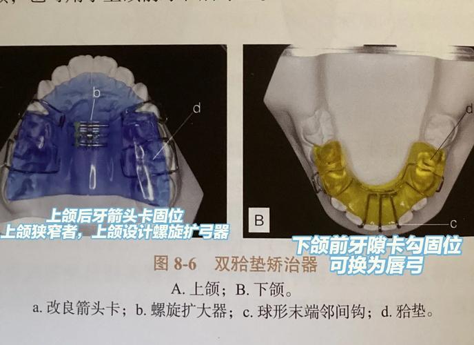 口腔正畸推簧如何正确使用？详细步骤与操作技巧解析-图2