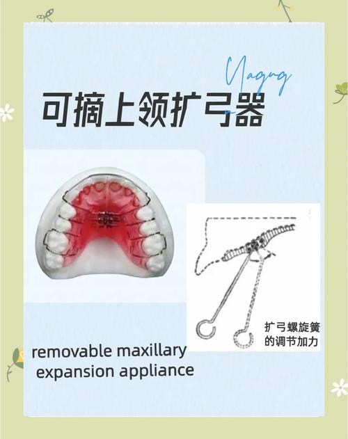 螺旋扩弓器制作方法步骤具体是怎样的?-图2 螺旋扩弓器制作方法步骤具体是怎样的?-图2
