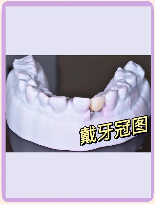 种植牙牙槽骨厚度太薄，能成功种植吗？-图2