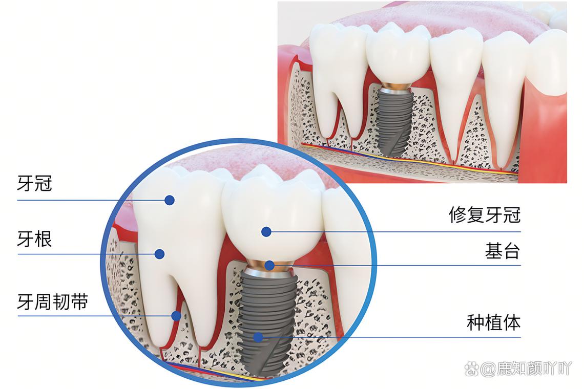 济南哪家医院种牙技术好？求靠谱推荐！-图1