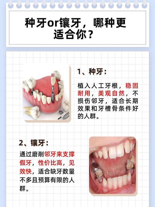 大牙镶牙与种牙,哪个更适合?-图3 大牙镶牙与种牙,哪个更适合?-图3