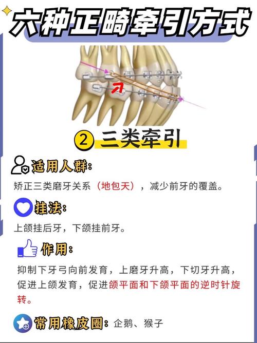 正畸里面牵引钩的具体形态和外观长什么样?-图2 正畸里面牵引钩的具体形态和外观长什么样?-图2