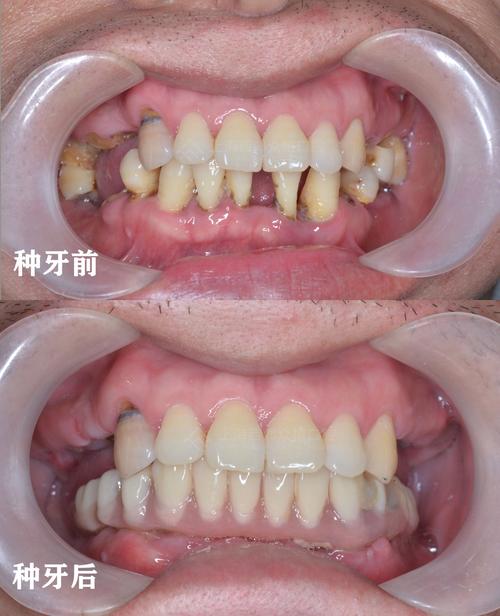 种两颗牙能恢复半口牙吗?-图3 种两颗牙能恢复半口牙吗?-图3