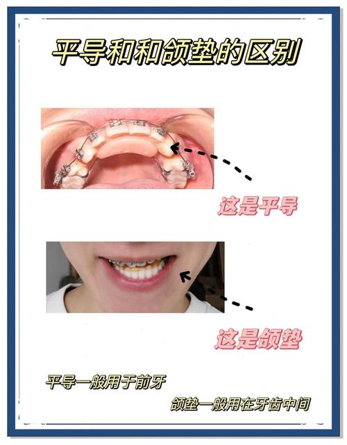 正畸平导是厚的还是薄的-图2