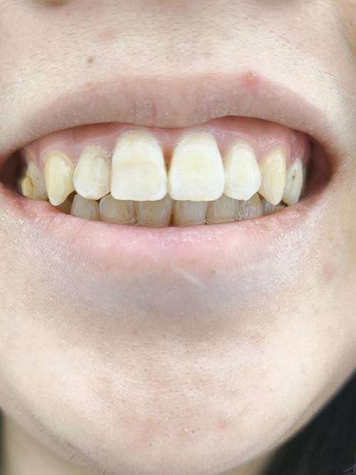 正畸后牙侧壁出现一条线，是牙齿损伤还是矫正正常反应？-图1