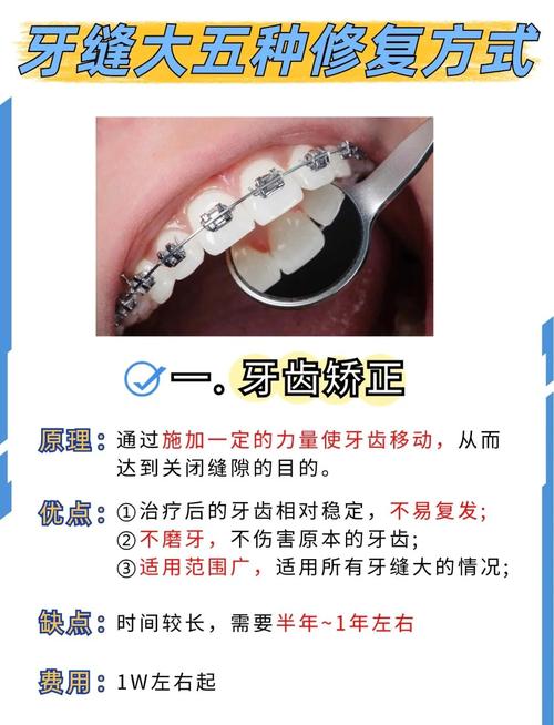 门牙缝隙大如何有效关闭？矫治方法有哪些？-图2