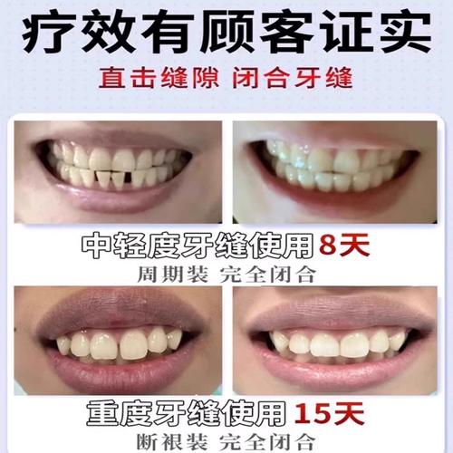 门牙缝隙大如何有效关闭?矫治方法有哪些?-图1 门牙缝隙大如何有效关闭?矫治方法有哪些?-图1