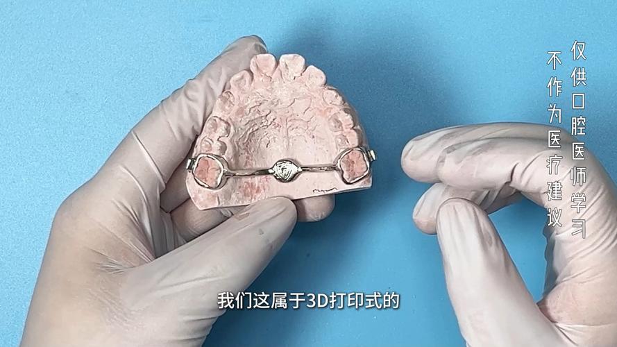 正畸横腭杆一般要戴多久？-图2