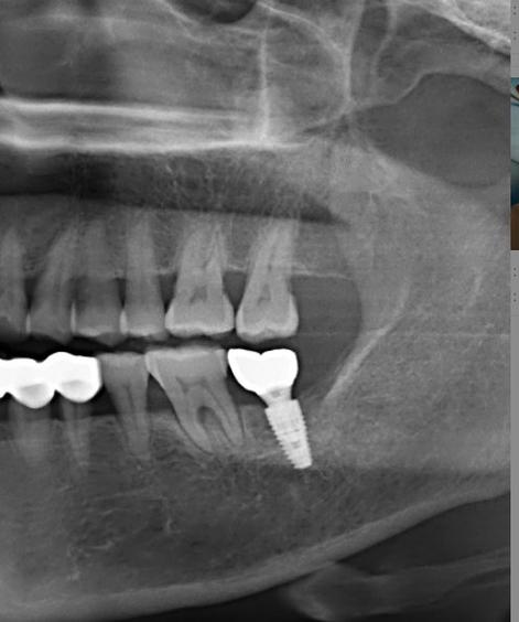 嘉兴种牙去哪儿好？靠谱医院医生怎么选？-图1
