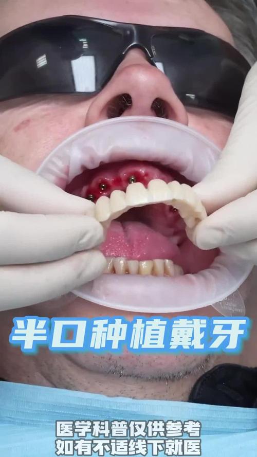 半口牙拔除后种牙全过程,到底要经历哪些关键步骤?-图1 半口牙拔除后种牙全过程,到底要经历哪些关键步骤?-图1