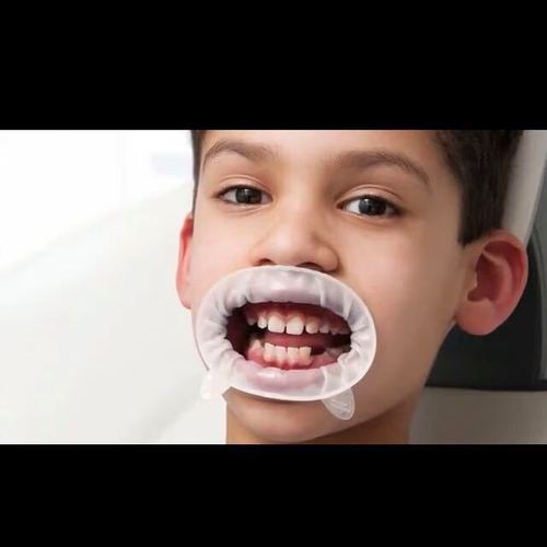 义获嘉开口器的使用方法-图1 义获嘉开口器的使用方法-图1