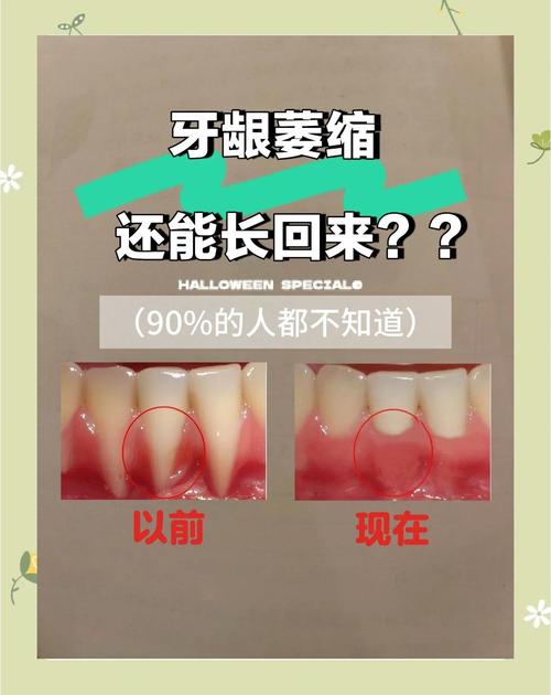 老人牙槽骨萎缩能种牙吗？-图1