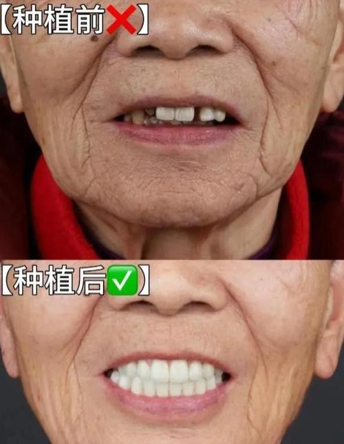 老人牙槽骨萎缩能种牙吗？-图3