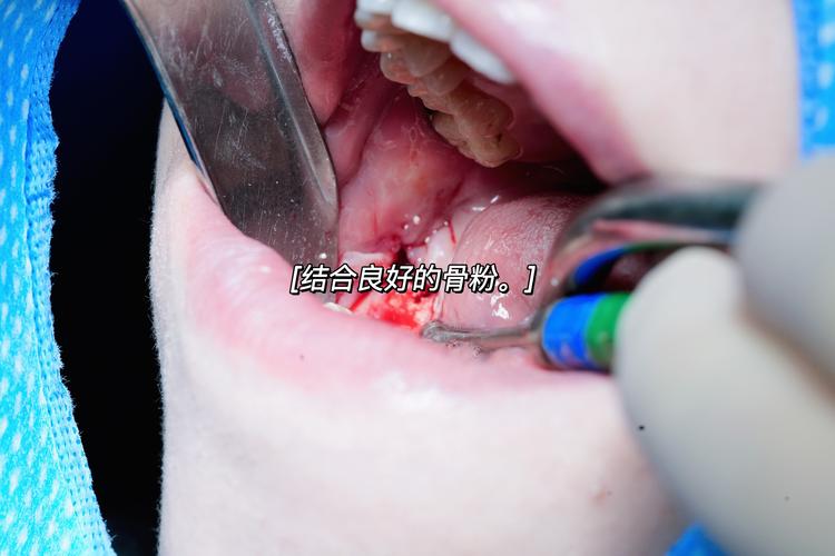 河南矫牙种牙援助计划谁能申请？如何申领？-图1