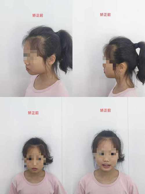 上门牙缺一个，正畸能修复好吗？-图2