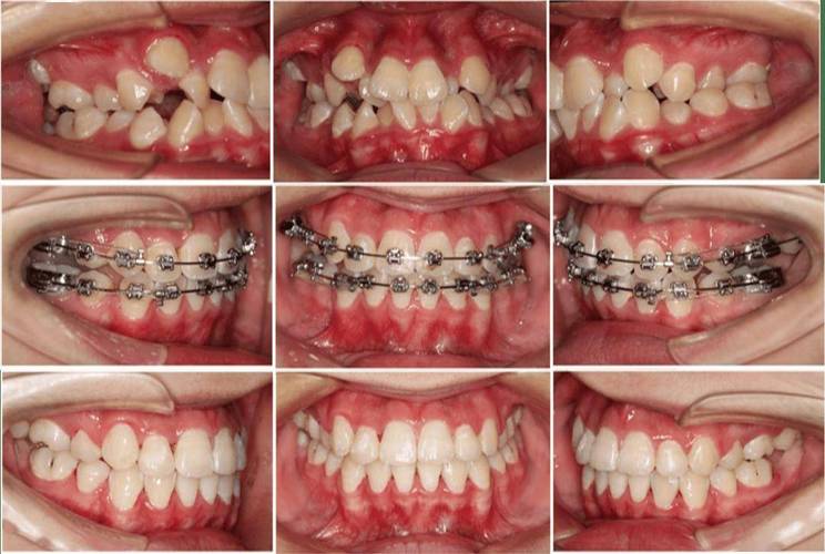 弯制正畸矫治器实验总结-图3