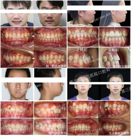正畸中线为何越来越歪?是正常现象还是需调整?-图1 正畸中线为何越来越歪?是正常现象还是需调整?-图1