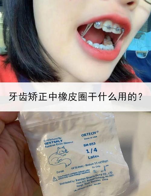 正畸橡皮圈怎么挂最简单？新手一看就会的技巧！-图3