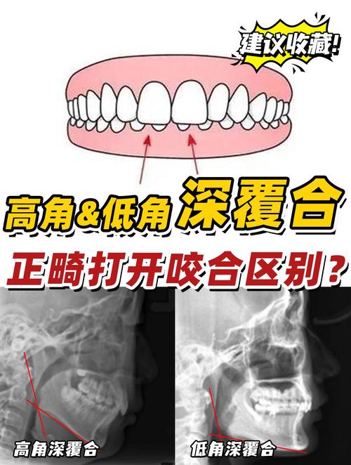 正畸治疗中高角与低角如何区分？治疗策略有何不同？-图2