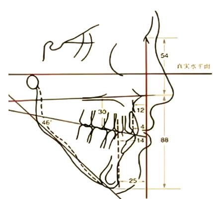 正畸治疗中高角与低角如何区分?治疗策略有何不同?-图3 正畸治疗中高角与低角如何区分?治疗策略有何不同?-图3