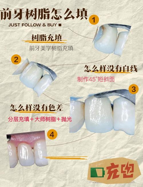 复合树脂充填的方法和步骤具体如何规范操作？-图3