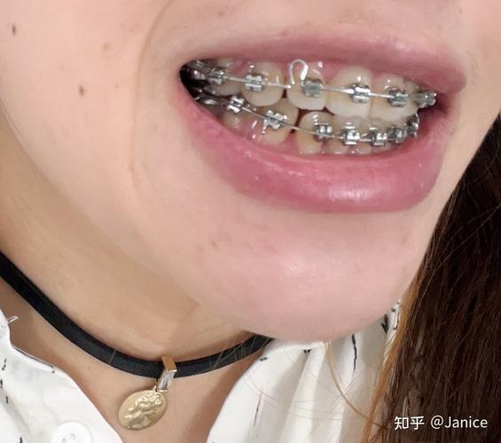南京市口腔医院正畸效果怎么样?真实案例与效果评价如何?-图1 南京市口腔医院正畸效果怎么样?真实案例与效果评价如何?-图1
