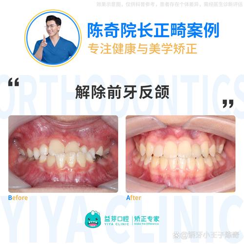 个别牙反颌的解决方法有哪些?-图3 个别牙反颌的解决方法有哪些?-图3