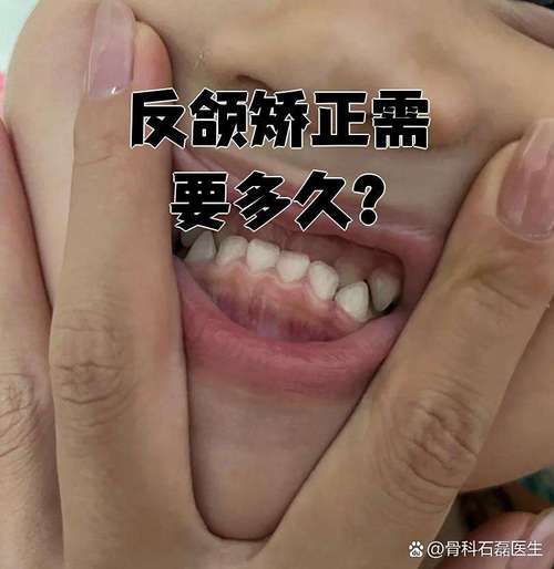 个别牙反颌的解决方法有哪些?-图1 个别牙反颌的解决方法有哪些?-图1