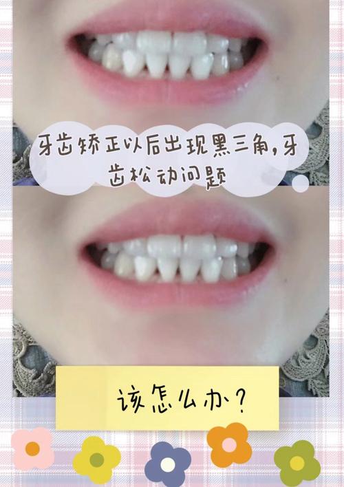 黑三角存在时,正畸可行吗?效果如何?-图1 黑三角存在时,正畸可行吗?效果如何?-图1