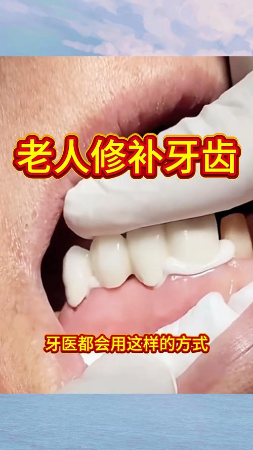 老年人牙齿修复有哪些方法?-图3 老年人牙齿修复有哪些方法?-图3