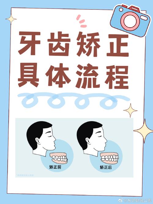 如何最短时间矫正牙齿?-图2 如何最短时间矫正牙齿?-图2