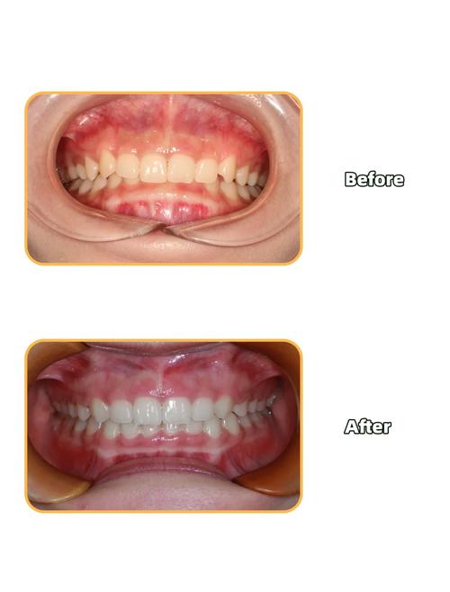深覆合能自行矫正吗?有哪些安全有效的方法?-图2 深覆合能自行矫正吗?有哪些安全有效的方法?-图2