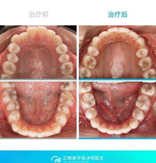 骨性错颌畸形矫治方法有哪些?如何选择最佳矫治方案?-图2 骨性错颌畸形矫治方法有哪些?如何选择最佳矫治方案?-图2