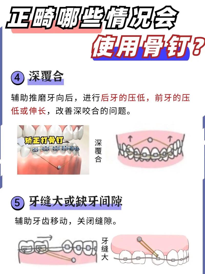 正畸微螺丝钉有何作用？-图3
