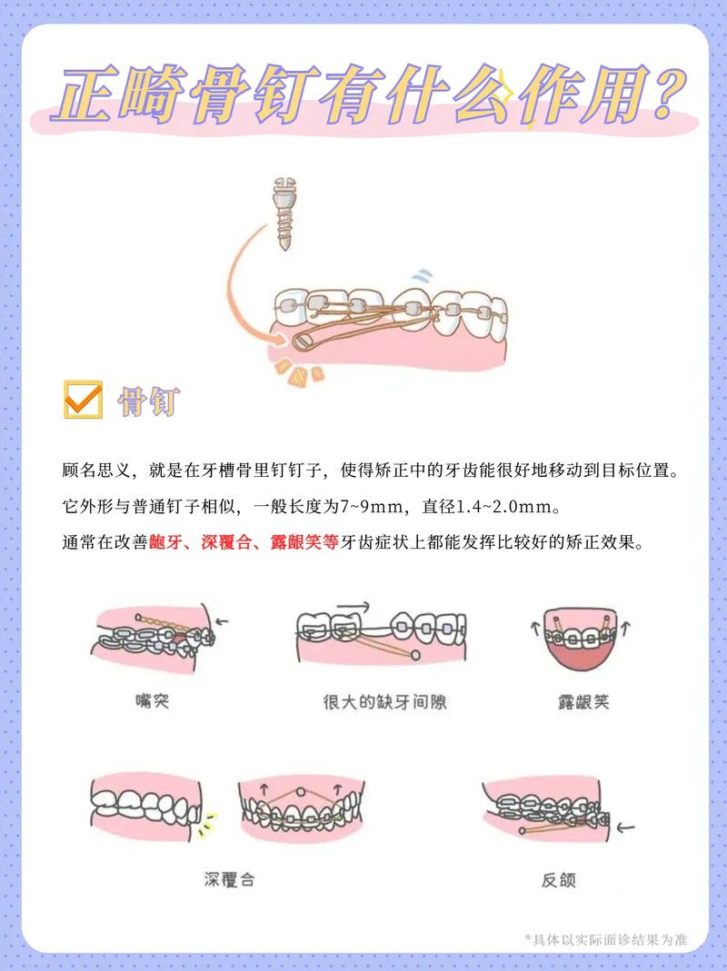 正畸微螺丝钉有何作用?-图1 正畸微螺丝钉有何作用?-图1